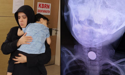 Çocuğun boğazına takılan madeni para hastanede çıkarıldı