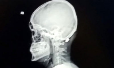 Maganda kurşunuyla vurulan genç: 1 santim daha girse felç kalabilirdim