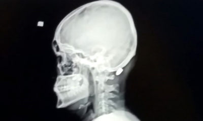 Maganda kurşunuyla vurulan genç: 1 santim daha girse felç kalabilirdim