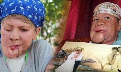 ÇENESİNDE ÇIKAN SİVİLCE KADININ HAYATINI KARARTTI!.