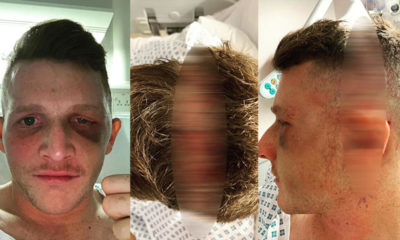 KORKUNÇ SAKATLIK!. YILDIZ SPORCU GÖZÜNÜ KAYBETTİ!.