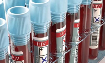 Dünya AIDS hastalığını bitirmek için zamanla yarışıyor!