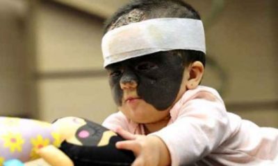 ‘Batman’ maskesiyle doğan bebeğin iyileşmesi için on bimlerce kişi seferber oldu!.