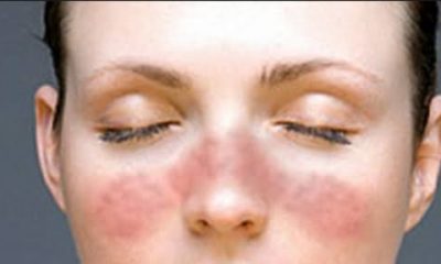 Lupus Hastalığı nedir?. Belirtileri ve tedavisi nelerdir?.