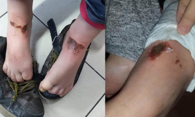 Karla oynayan çocukların gizemli yanıklarının nedeni belli oldu!.