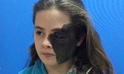 Nazlı’nın yüzünün yarısını kaplayan ben ameliyatla alınacak!.