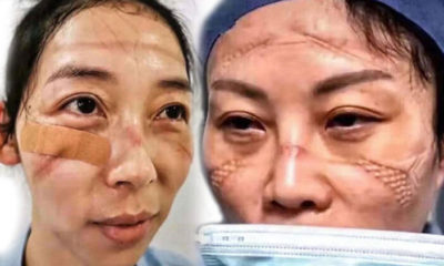 Çinli doktorların virüsle mücadelesi… Maskeler yüzlerinde iz bırakmış!.