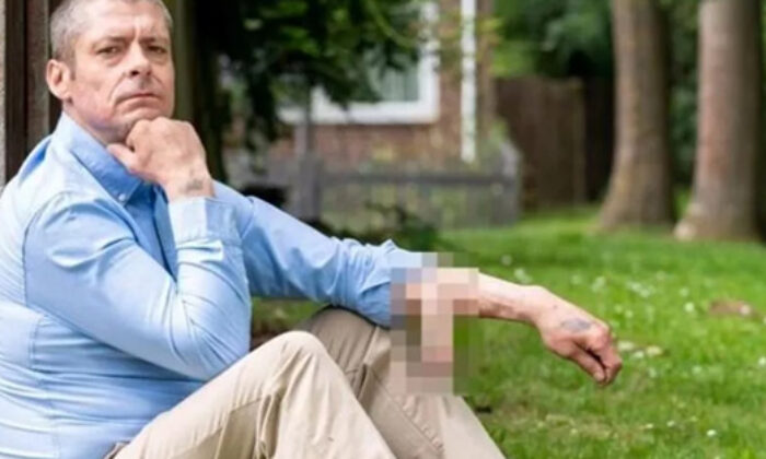 4 yıldır koluna dikilen penisle yaşıyor!.