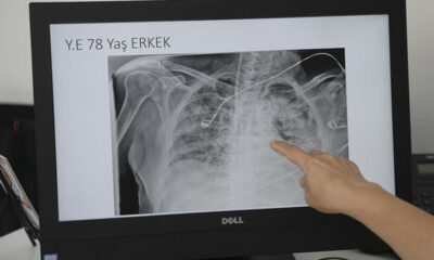 Coronavirüsün akciğerde bıraktığı ağır tahribat görüntülendi!.