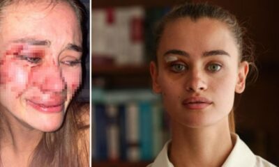 Çeşme’de darp edilen Ukraynalı model ilk defa konuştu! ”Biri 60 yaşındaydı!.”