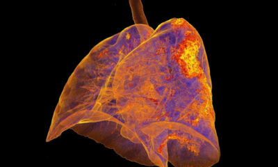 “Virüsün akciğerlere verdiği hasar inanılmaz..”