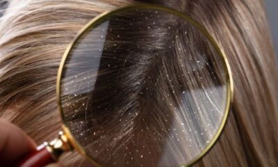 Bunları yapıyorsanız kepek sorunundan kurtulamazsınız!.