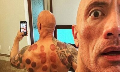 Dünyanın ünlü isimleri hacamatla tedavi oluyor!.