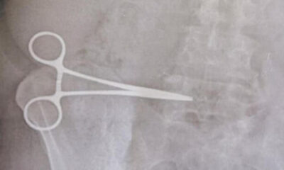 Ameliyatta karnında makas unuttular!.