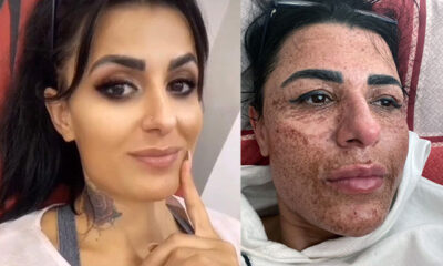 Antalya’da ilanla cilt bakımı yaptırdı, 8 ayda yüzünün yalnızca yüzde 60’ı iyileşebildi!.