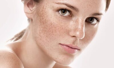 Kimyasallara mecbur değilsiniz! Cilt lekelerinden doğadan gelen sağlıkla kurtulun!.