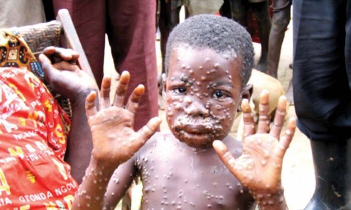 DSÖ acil koduyla toplanıyor! Maymun çiçeği virüsü 11 ülkede görüldü!.