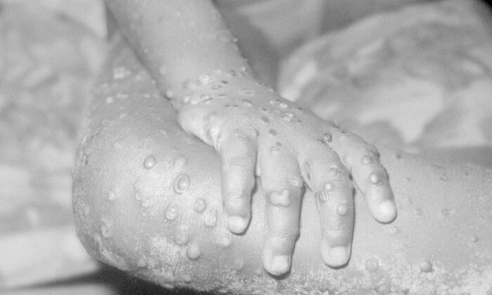 Yunanistan’da ilk maymun çiçeği vakası görüldü!.