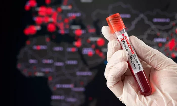 92 ülkede görülen maymun çiçeği virüsünde vaka sayısı 35 bini aştı!.