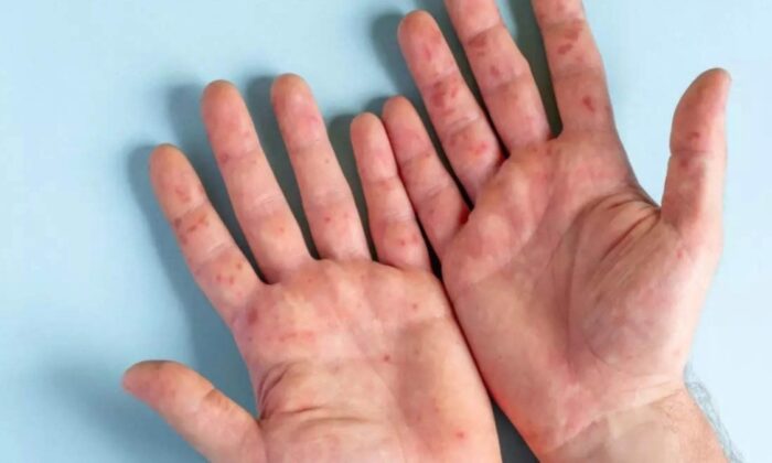 Gana’da, maymun çiçeğinden ilk ölüm gerçekleşti!.