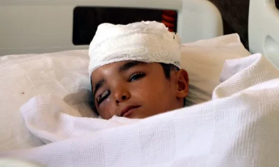 Yine aynı dehşet! Gaziantep’te sokak köpeği küçük çocuğun kafa derisini koparttı!.