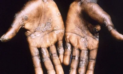 Maymun Çiçeği Virüsü evcil hayvanlara bulaşır mı?.